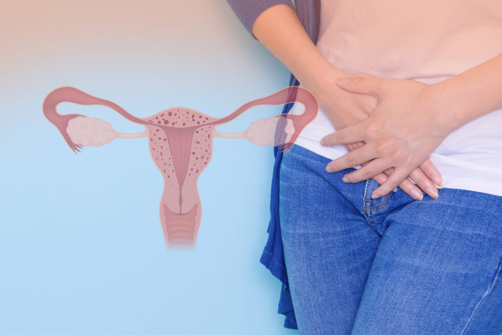 Adenomiose e infertilidade feminina Adenomiose e infertilidade feminina