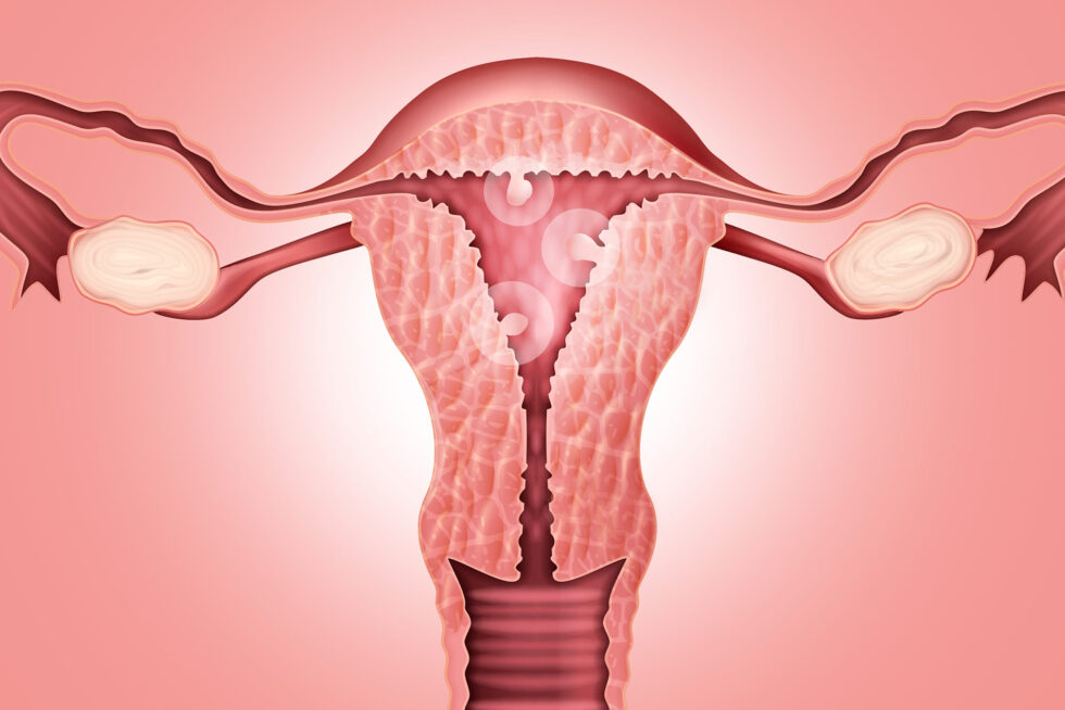 Endométrio e fertilidade Endométrio e fertilidade