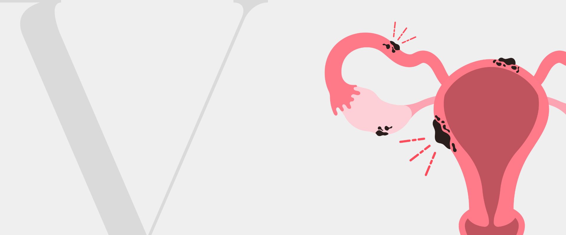 Endometriose O que É Quais os Sintomas Endometriose O que É Quais os Sintomas